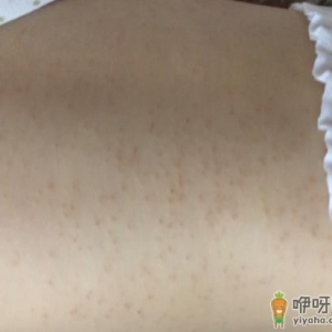 宝宝有湿疹可以喂母乳吗 宝宝湿疹擦什么面霜