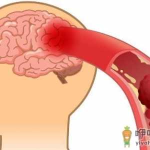 防中风控制好六大因素 生活中对中风病的日常误区