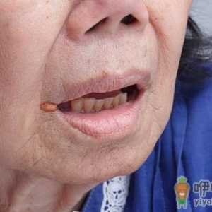 精神压力大易导致口腔溃疡 中医偏方可治疗口腔溃疡