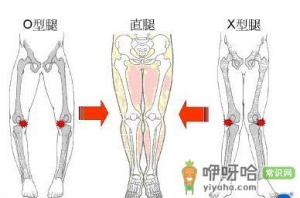 5种走路姿势会让你变成O型腿